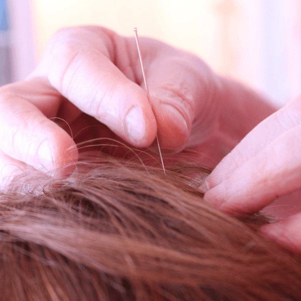 Acupuntura seguimiento