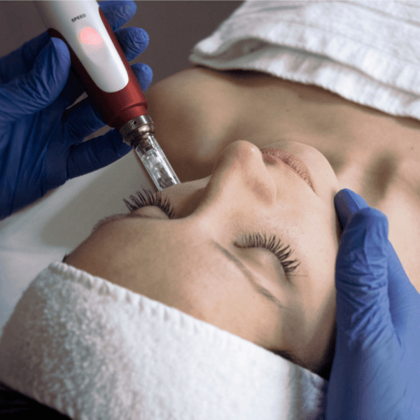Sesión Microneedling