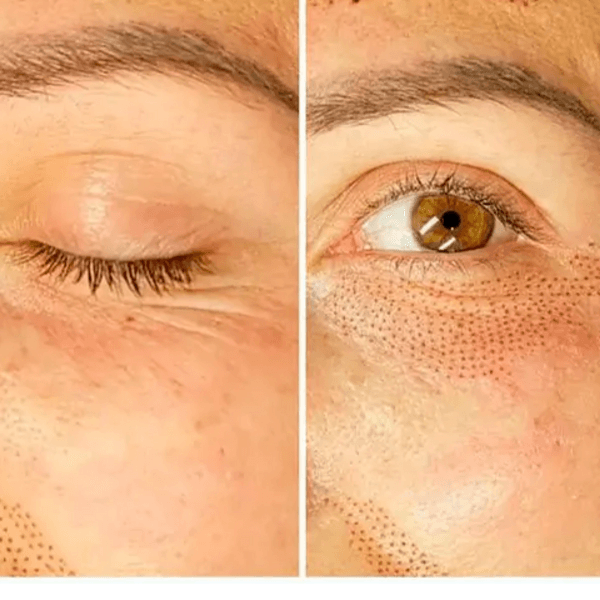 Reducción de Bolsas, Párpados y Surcos con Plasma Fraccionado 1 Sesión