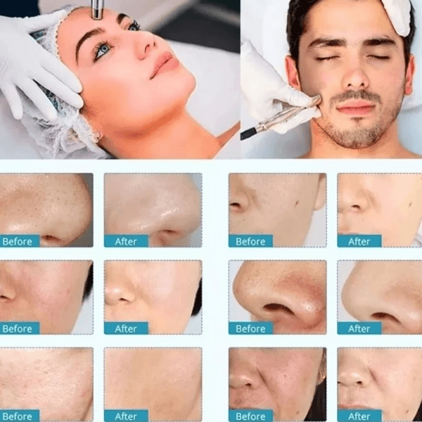 Limpieza facial con microdermoabrasión