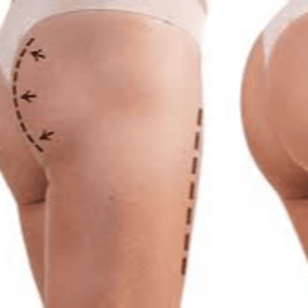 Aumento/Lifting de glúteo