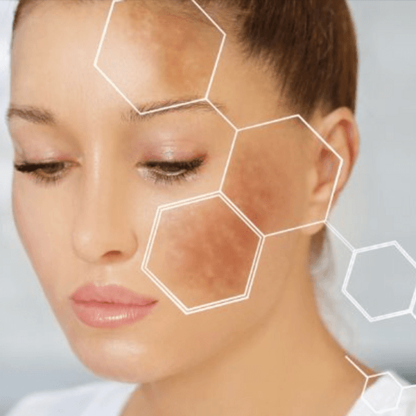 Peeling Tratamiento de Manchas 4 Sesiones