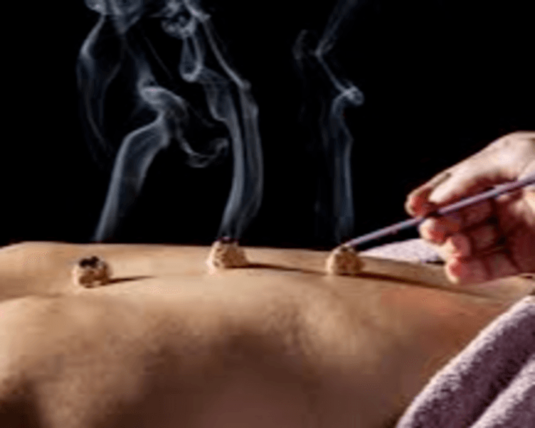 Acupuntura - Medicina China