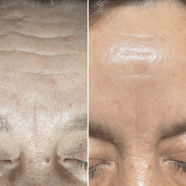 Antiedad AGF Mesenchymal Exosomas