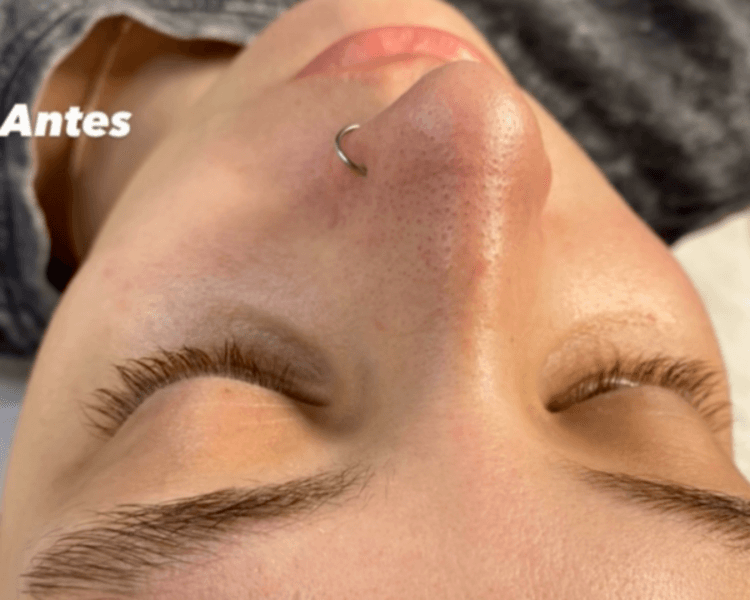 LIMPIEZA FACIAL PROFUNDA