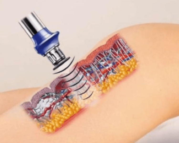 Ultrasonido ( Piernas )