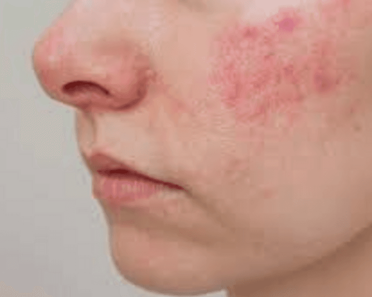 Limpieza Facial para piel con ROSACEA