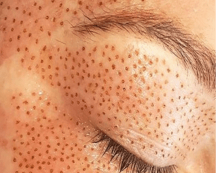 Fibroblast/ Plasma Pen 10x5 Facial (por zona)