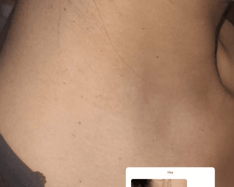 Remoción Acrocordones