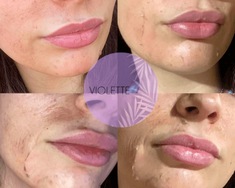 Peeling descamante (colocación de ácido)