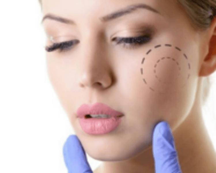 HIFU 10D Cara zona inferior