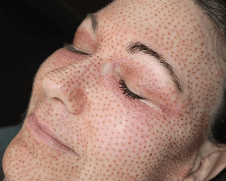 Fibroblast/ Plasma Pen Full Face