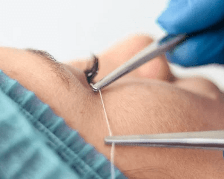 Hilos Nube (Líneas de expresión finas)