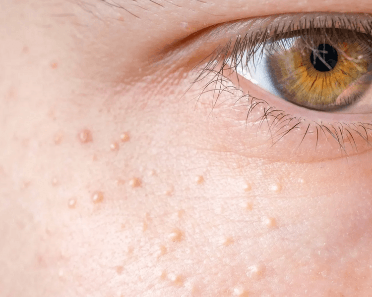 Limpieza con Extracción de quiste de MILIUM