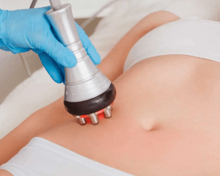 Radiofrecuencia (Abdomen y Flancos)