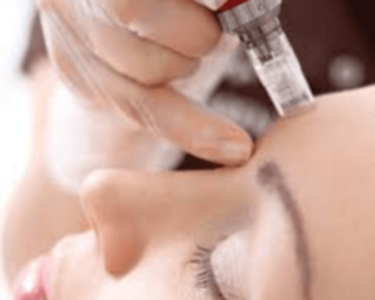 Microneeding Plus (Con extracción de puntos negros)