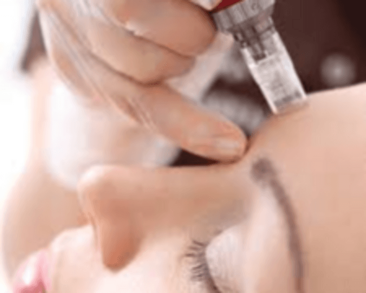 Microneeding Plus (Con extracción de puntos negros)