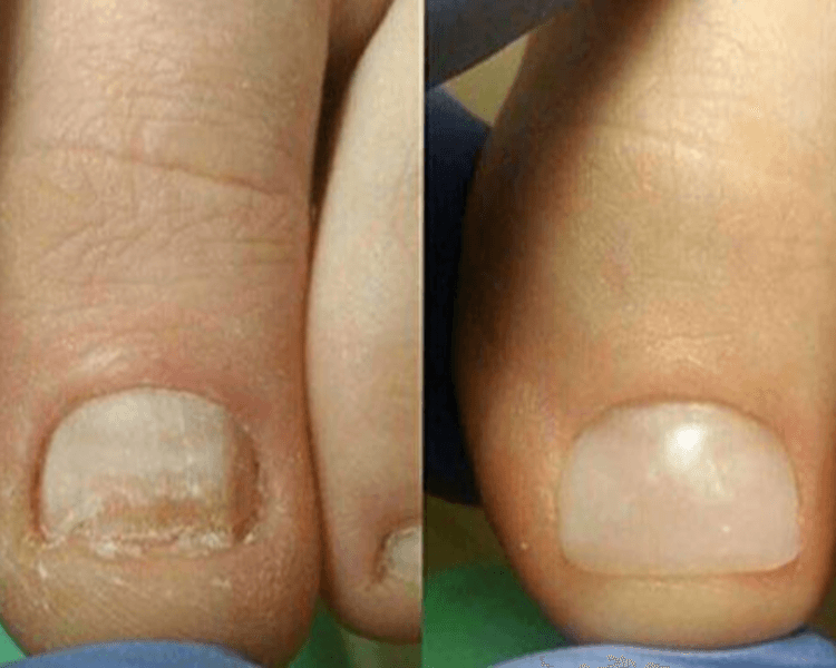 Reconstrucción de una uña (pie)