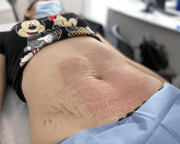 Fibroblast/ Plasma Pen Corporal (zona grande)