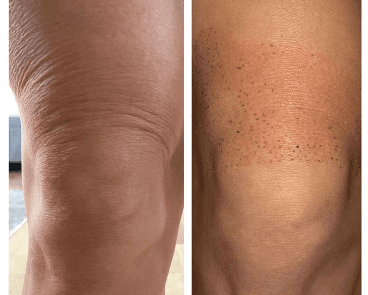 Fibroblast/ Plasma Pen Corporal (zona media)