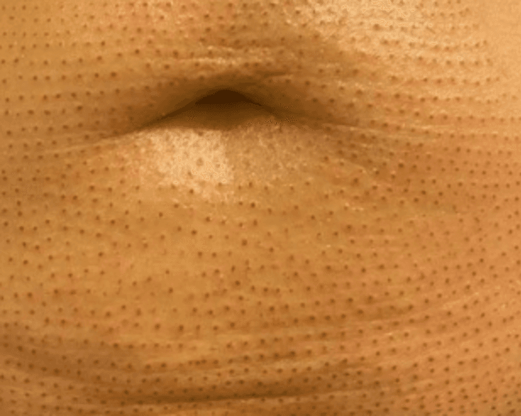 Fibroblast/ Plasma Pen Corporal (zona chica)