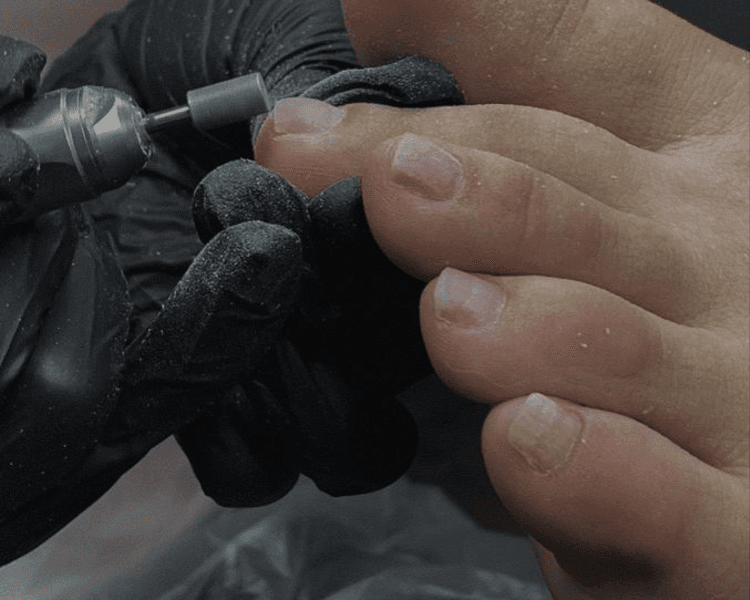 Retiro de gel en pies