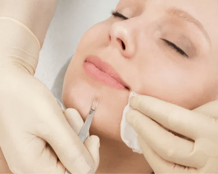 Facial + Extracciones