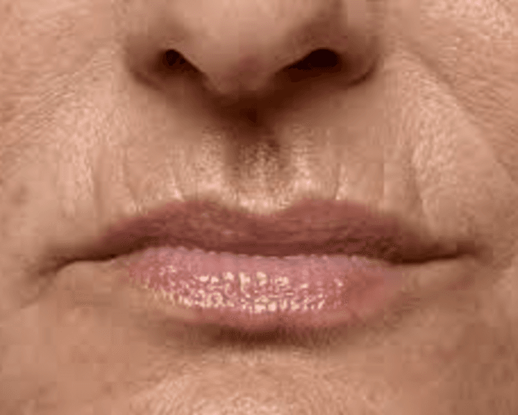 CODIGO DE BARRAS - ácido hialurónico