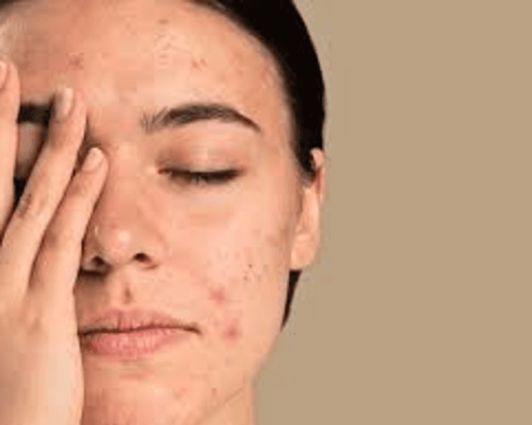 LIMPIEZA FACIAL ACNÉ