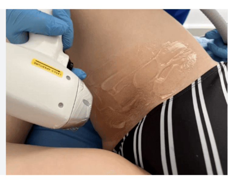 Rebaje Full brazil o medio bikini x6 sesiones