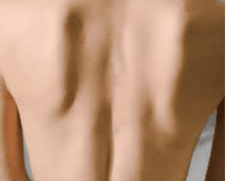 DEPILACION LASER MUJER : ESPALDA