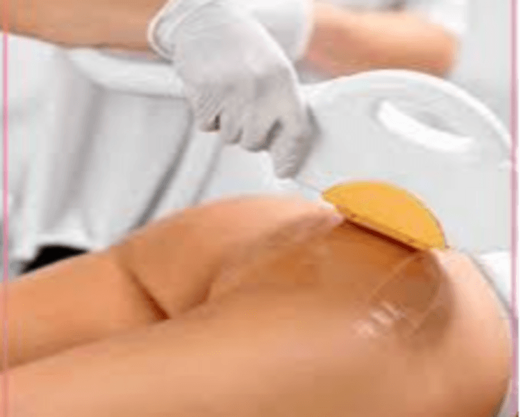 DEPILACION LASER MUJER : GLUTEOS