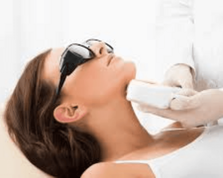 DEPILACION LASER MUJER : MENTON