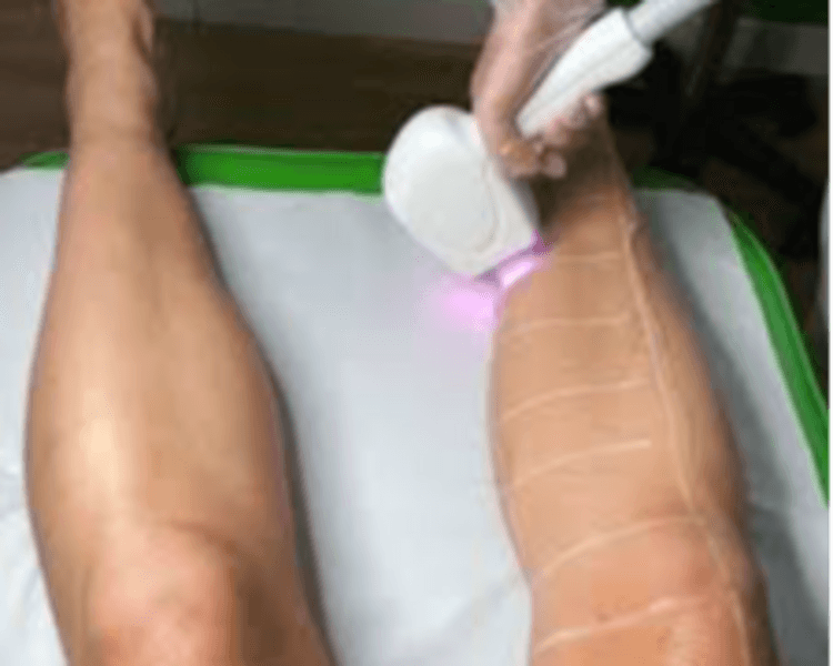 DEPILACION LASER HOMBRE :PIERNAS ENTERA