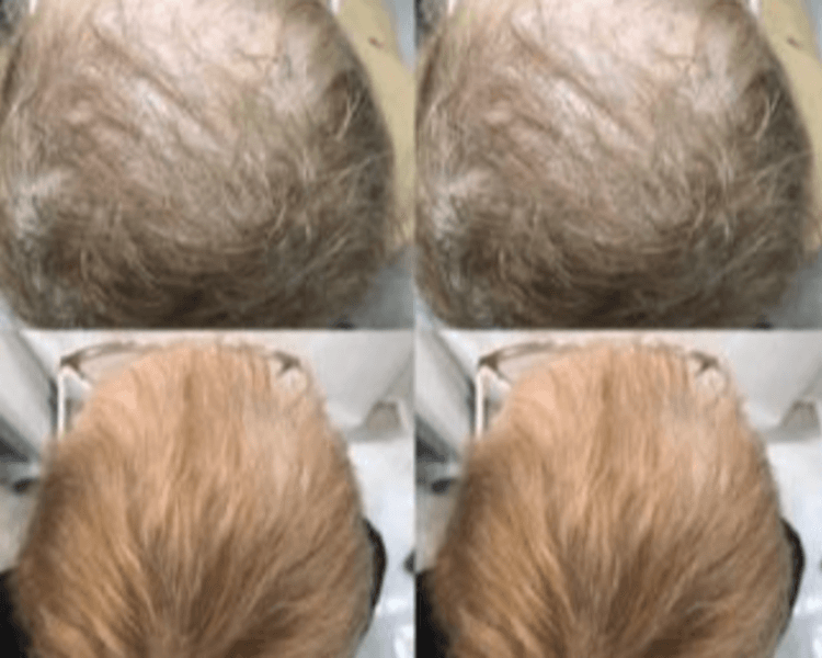 PLASMA RICO EN PLAQUETAS / P.R.P