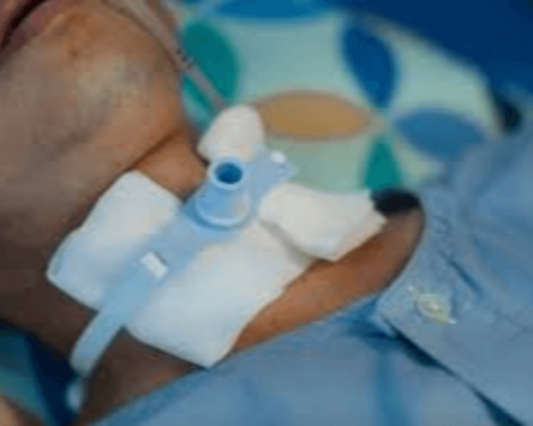 Atención a Usuarios Traqueotomizados o Conectados a Ventilación Mecánica No Invasiva (ISAPRE y PARTICULAR)