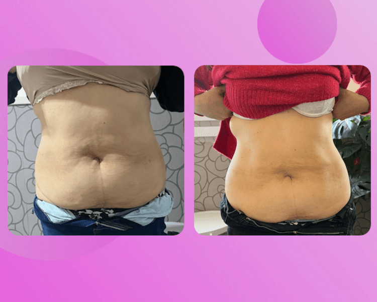 HYALURON PEN - SÚPER PROMO LANZAMIENTO - 6 SESIONES