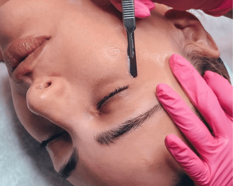 DERMAPLANING