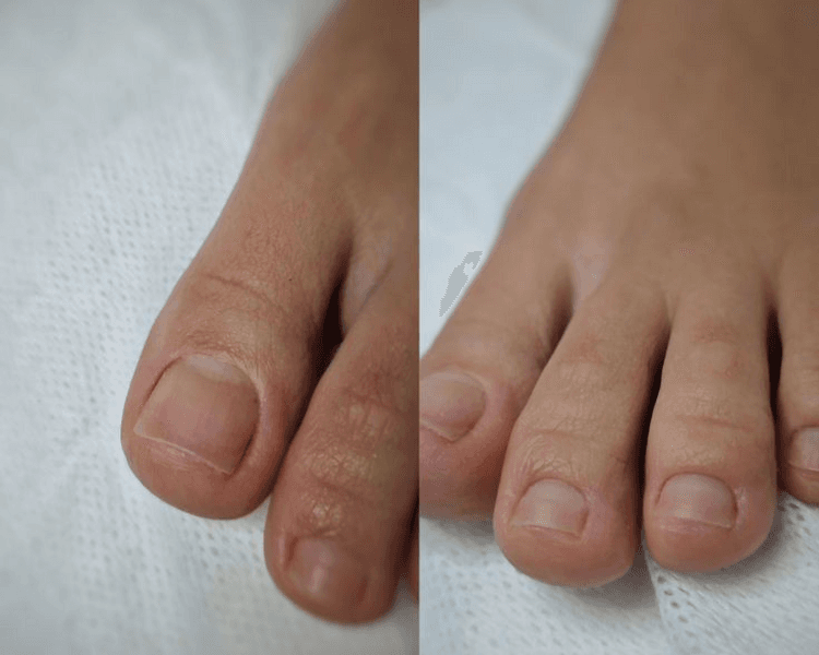 Pedicuria sin esmaltado