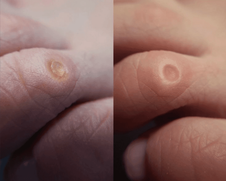 PROMO pies perfectos 🦶💅 : podología + pedicure permanente