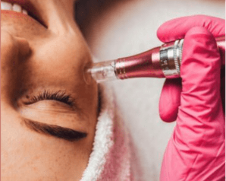 Rejuvenece y Revitaliza tu Piel /Microneedling con Dermapen.
