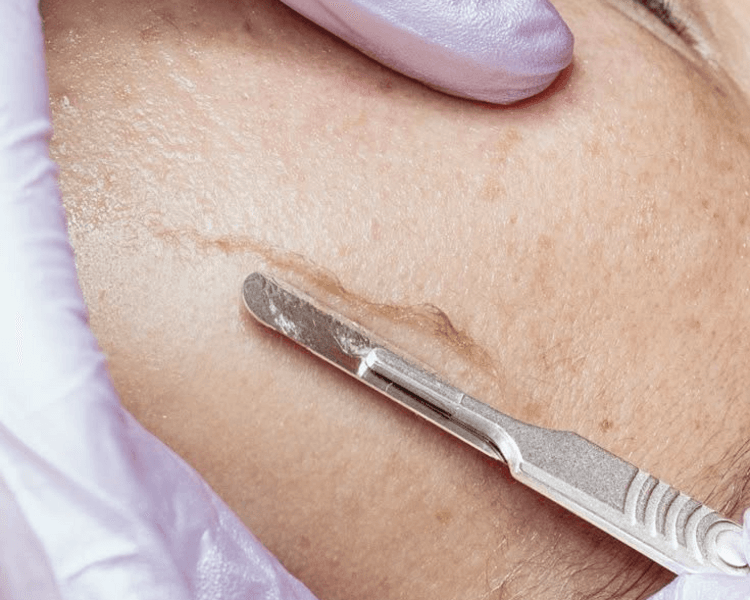 Sesion de dermaplaning