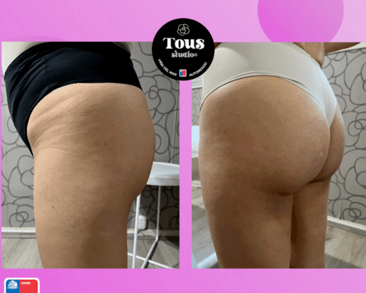 HYALURON PEN - SÚPER PROMO LANZAMIENTO - PUSH-UP GLÚTEOS