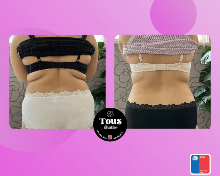 HYALURON PEN - SÚPER PROMO LANZAMIENTO - 2 SESIONES - QUEMA GRASA o ANTICELULITICO