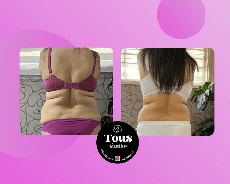 HYALURON PEN - PROMO LANZAMIENTO - SÚPER PACK QUEMA GRASA - REAFIRMANTE