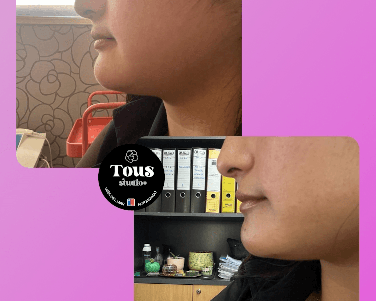 HYALURON PEN - SÚPER PROMO - DEFINICIÓN FACIAL