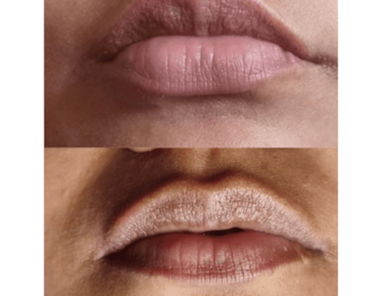 LABIOS NEUTRALIZACION