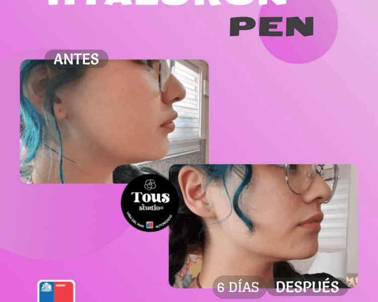 ⚪ EVALUACIÓN HYALURON PEN