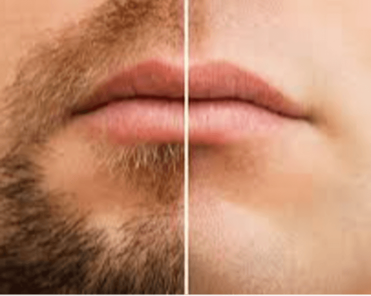 DEPILACION LASER HOMBRE : ROSTRO COMPLETO