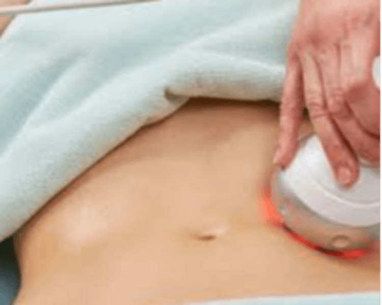 HIFU CORPORAL 14 D PRO MAX CON LIPOSONIC: ABDOMEN